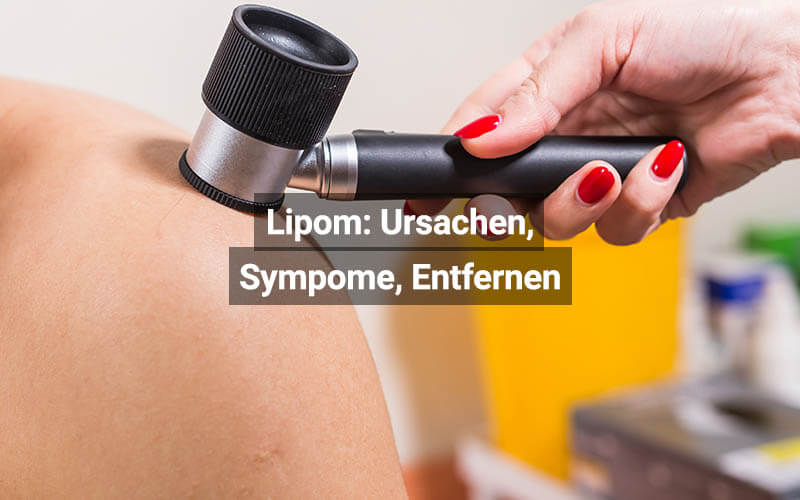Lipom (Haut Knubbel) Ursachen, Sympome, Entfernen