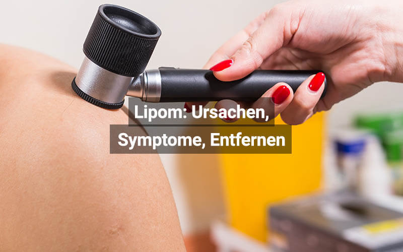 Lipom (Haut Knubbel) Ursachen, Symptome, Entfernen