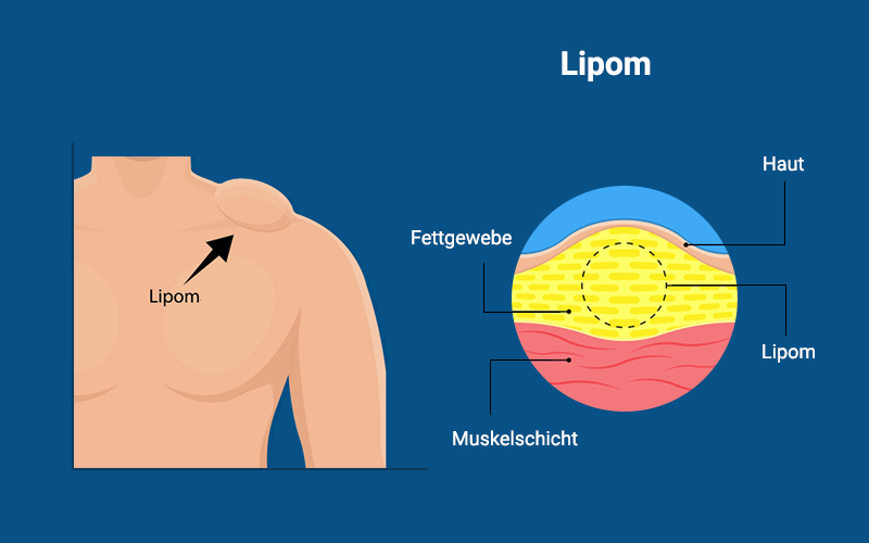 Lipom