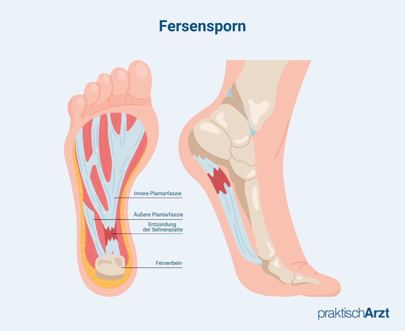 Fersensporn